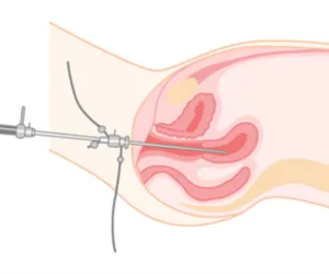 Non-Descent Vaginal Hysterectomy (Scarless Hysterectomy)