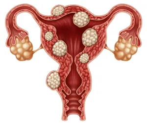 Myomectomy for Fibroids