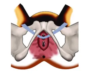 Stress Urinary Incontinence Surgery (TOT)