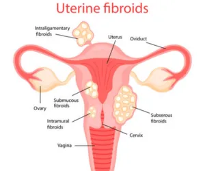 Uterine Issues