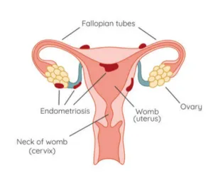 Endometriosis