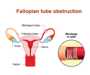 Fallopian Tube Blockage