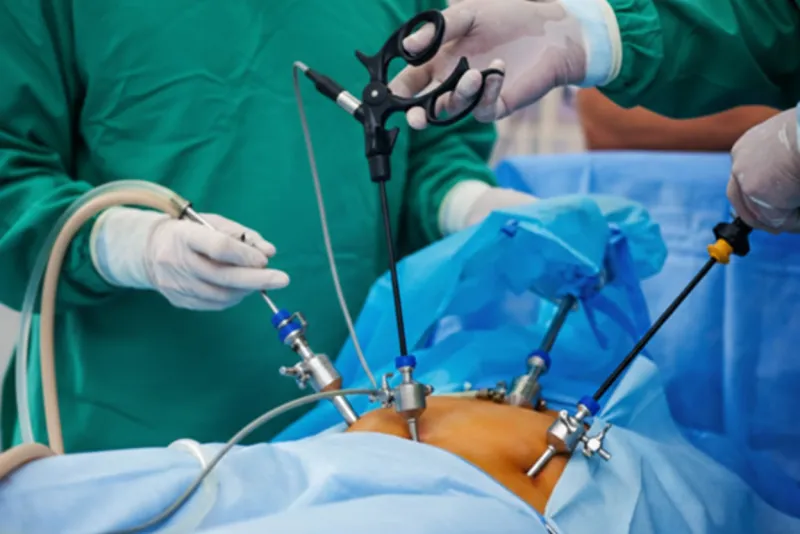 Minimally invasive laparoscopic surgery procedure