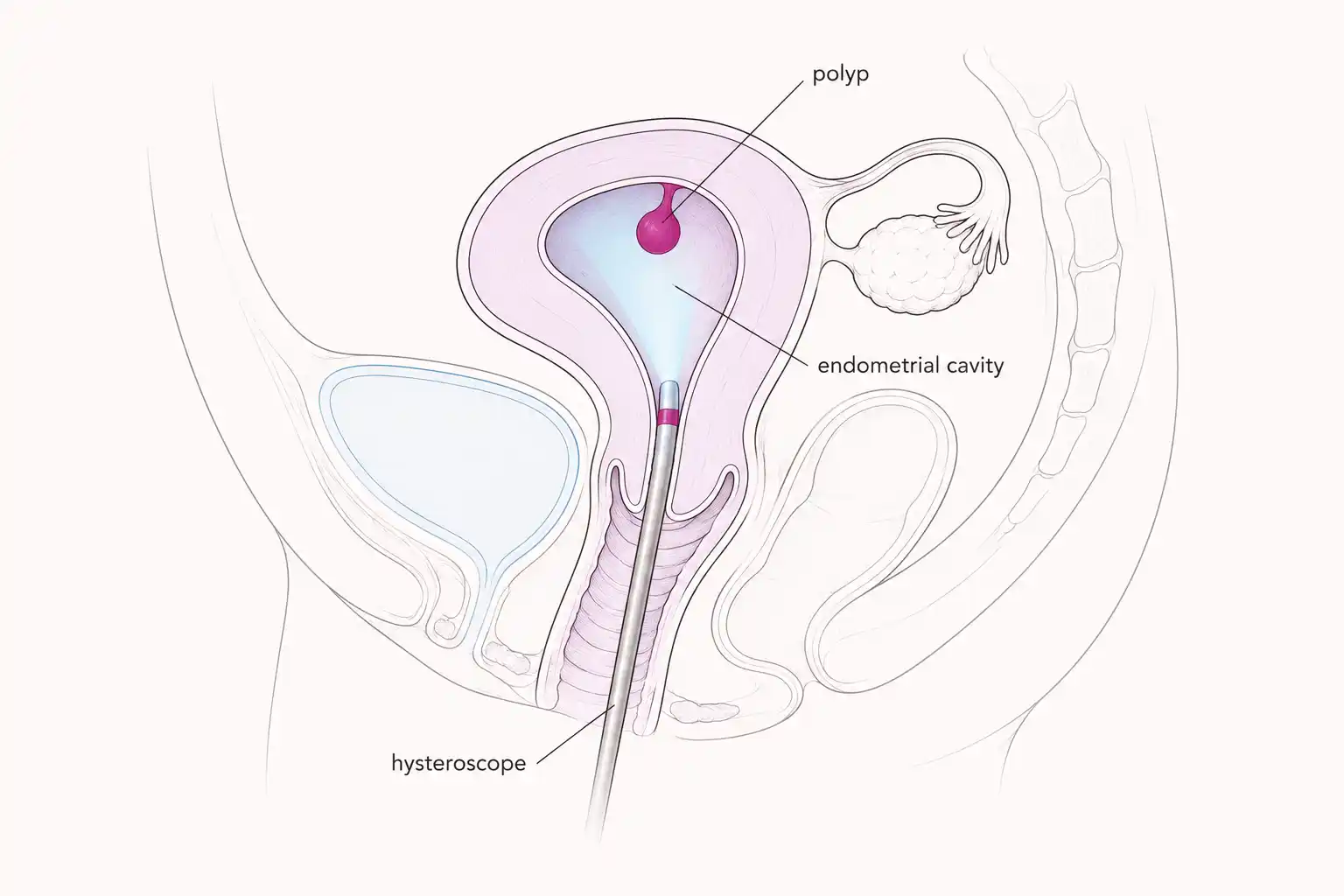 Medically accurate line-art illustration showing a sagittal view of the uterus with a hysteroscope entering through the cervix and a small endometrial polyp visible in the cavity