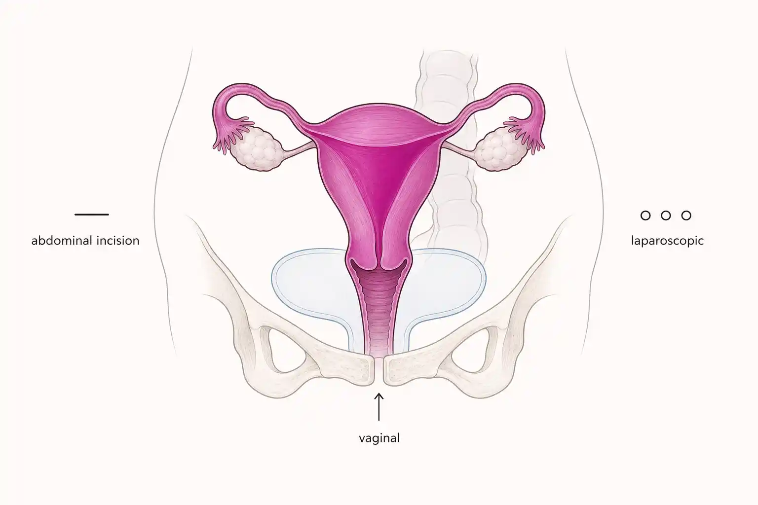 Medically accurate line-art illustration of the female uterus with the three hysterectomy routes (vaginal, abdominal, laparoscopic) indicated around it