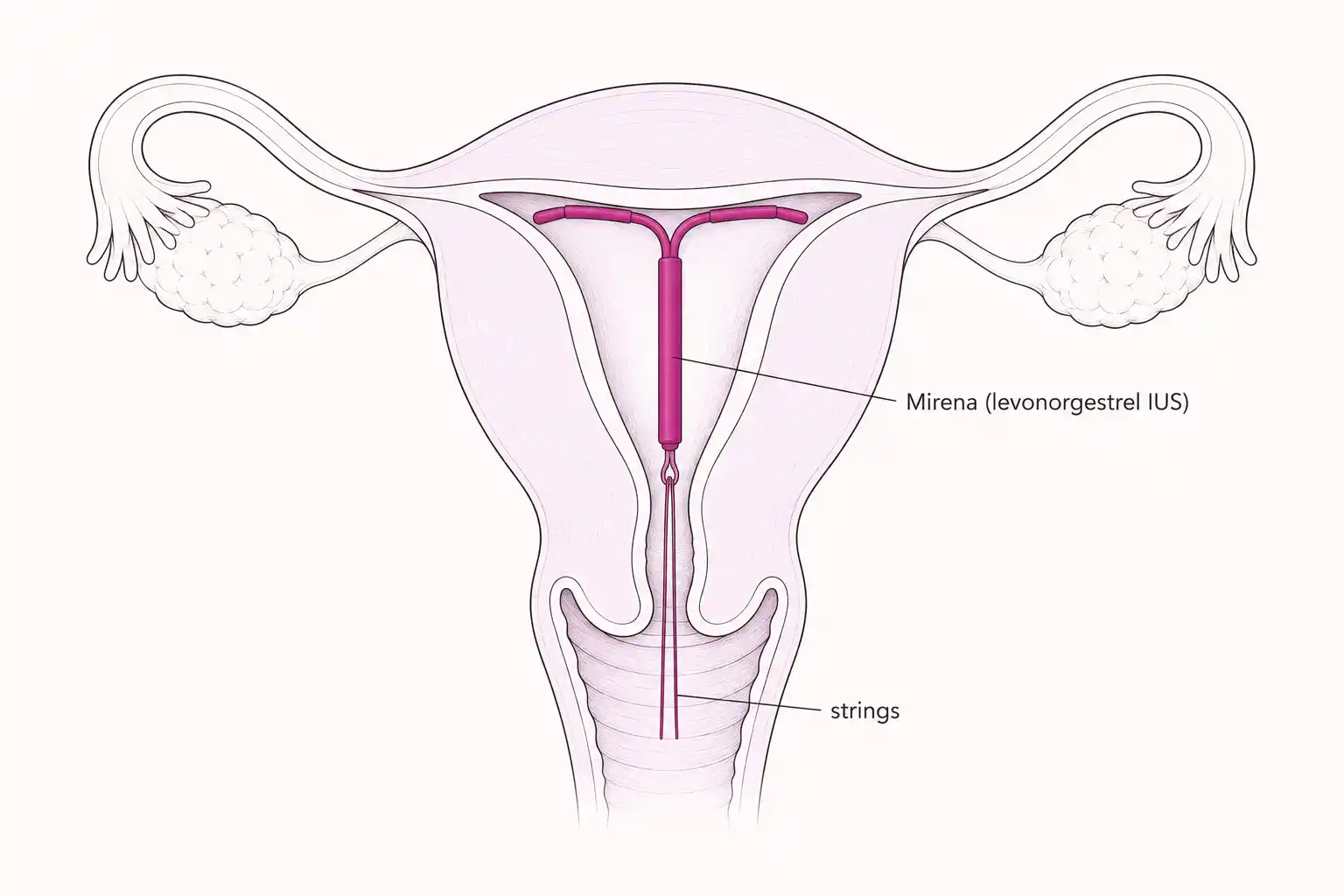 Medically accurate line-art illustration of a Mirena (levonorgestrel intrauterine system) correctly positioned at the uterine fundus with strings descending through the cervix
