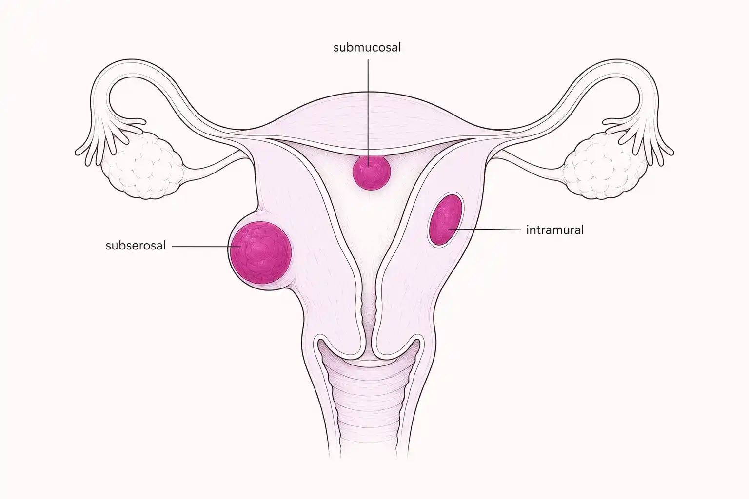 Medically accurate line-art illustration of a uterus showing the three types of fibroid by location (subserosal, intramural, submucosal) in brand-magenta accent