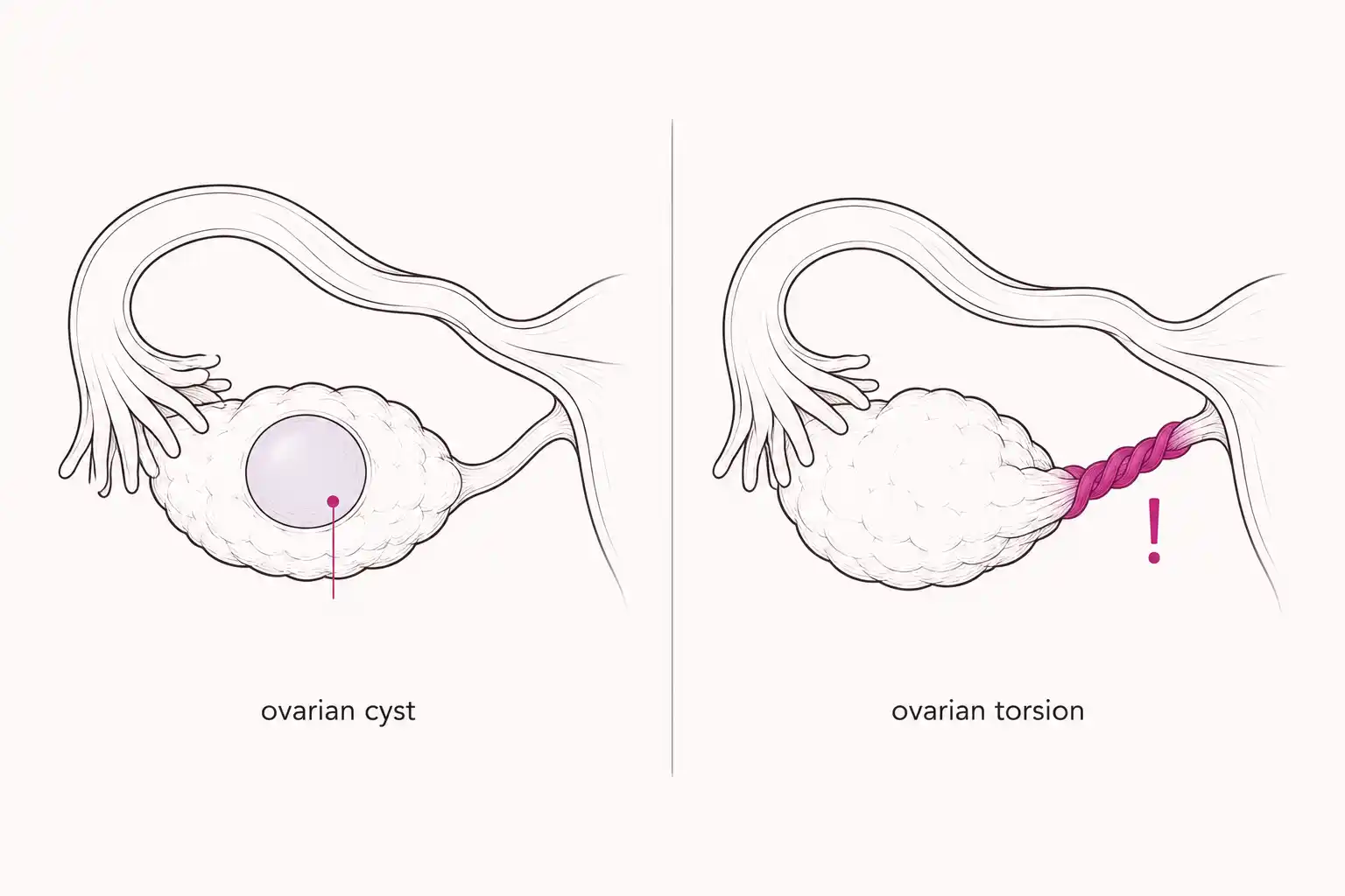 Medically accurate line-art illustration comparing a normal ovary with a simple cyst (left) and ovarian torsion with a twisted vascular pedicle (right)