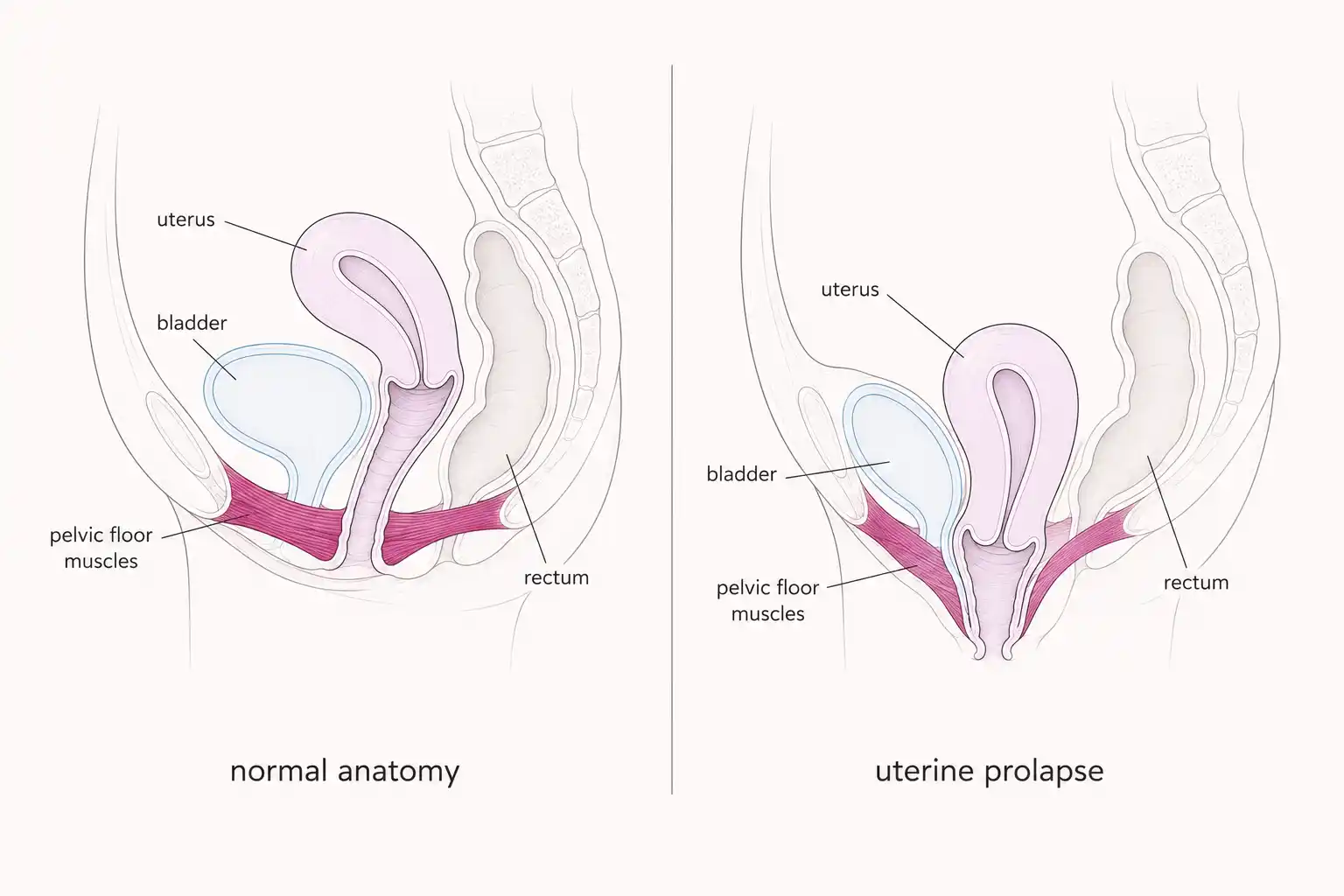 Medically accurate line-art illustration comparing normal pelvic anatomy with uterine prolapse, showing pelvic floor muscles in brand-magenta accent