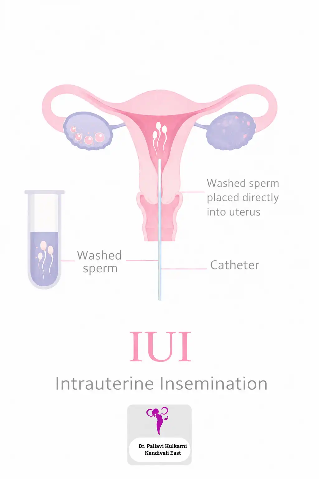 Intrauterine insemination (IUI) performed by Dr. Pallavi Kulkarni at a nearby fertility centre