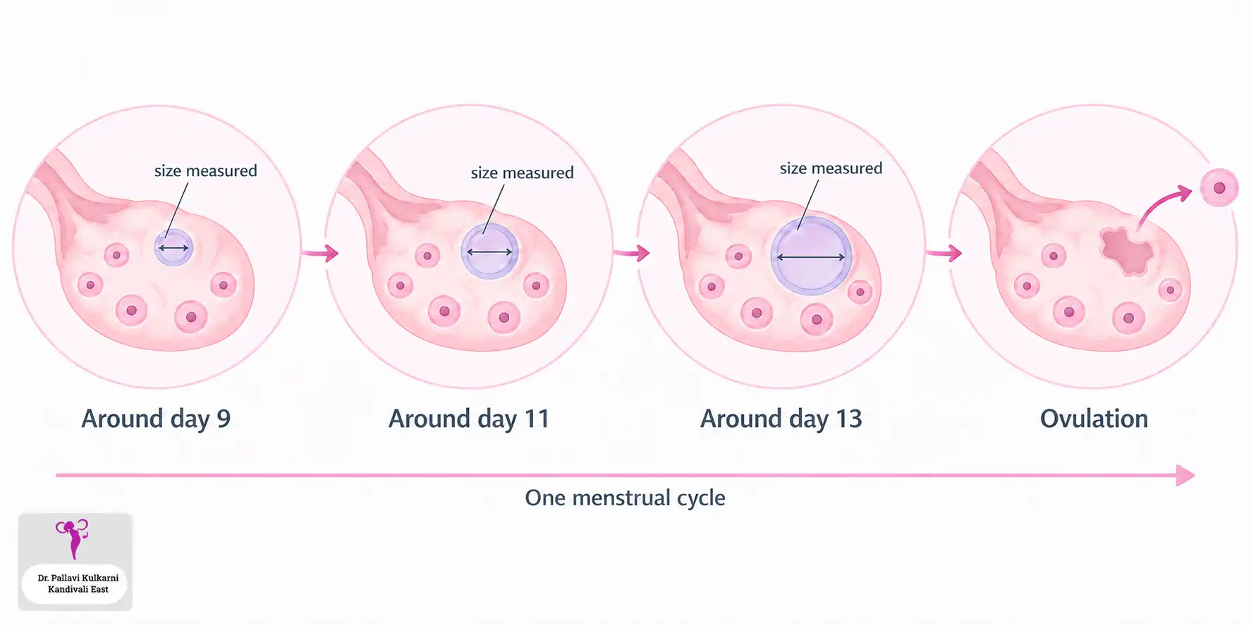 Follicular study across one cycle: a single follicle grows from around day 9 to day 13 and is measured at each scan, then releases the egg at ovulation