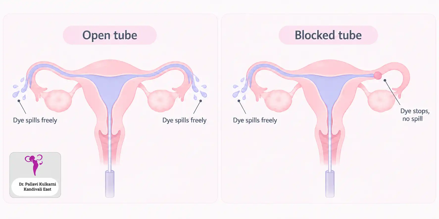 HSG comparison: on the left dye fills the uterus and spills freely from both fallopian tubes; on the right the dye stops at a blockage in one tube and does not spill