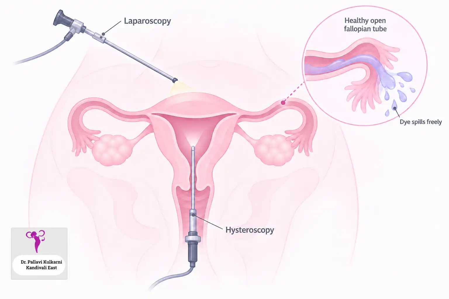 Hysterolaparoscopy: a hysteroscope passed through the cervix into the uterine cavity and a laparoscope viewing the pelvis from outside, with an inset showing a healthy open fallopian tube