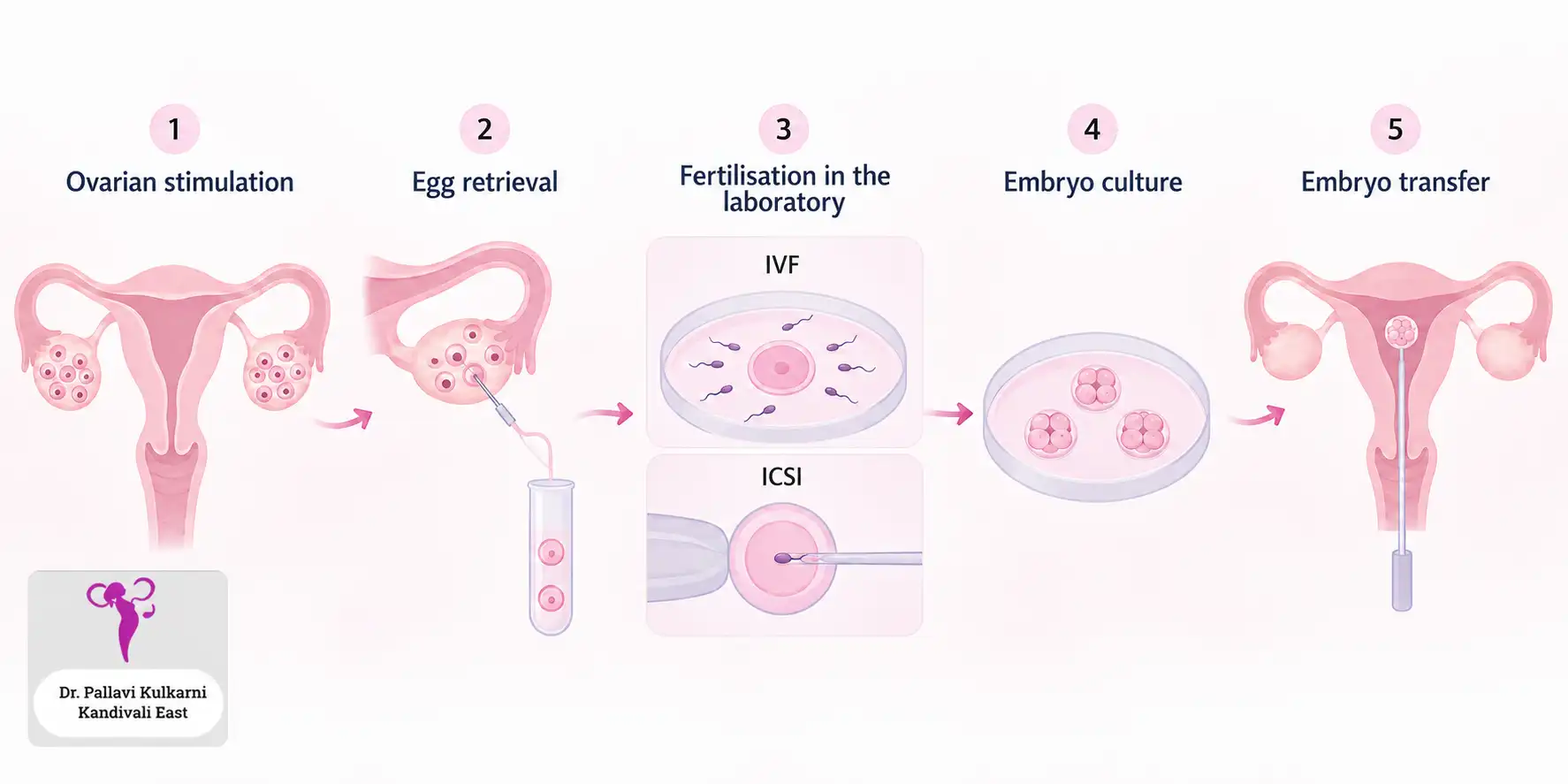 The five stages of IVF: ovarian stimulation, egg retrieval, fertilisation in the laboratory by either IVF or ICSI, embryo culture, and embryo transfer into the uterus