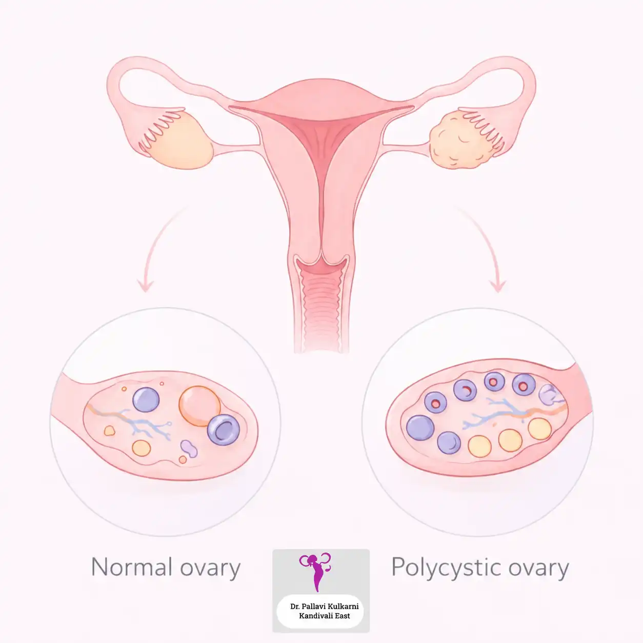 Ovulation induction with monitored cycles for women in Kandivali East