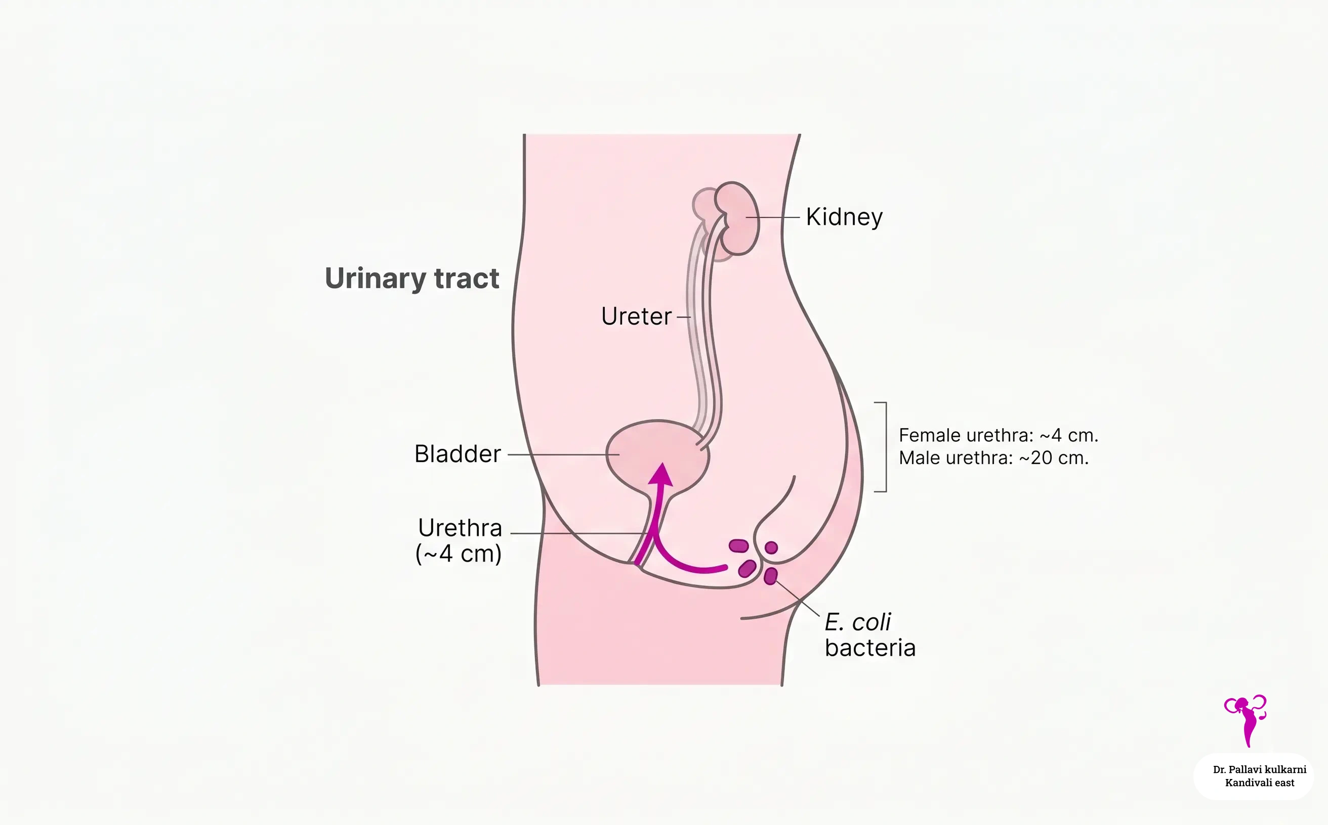Diagram showing how E. coli bacteria travel from the perineal area to the female bladder