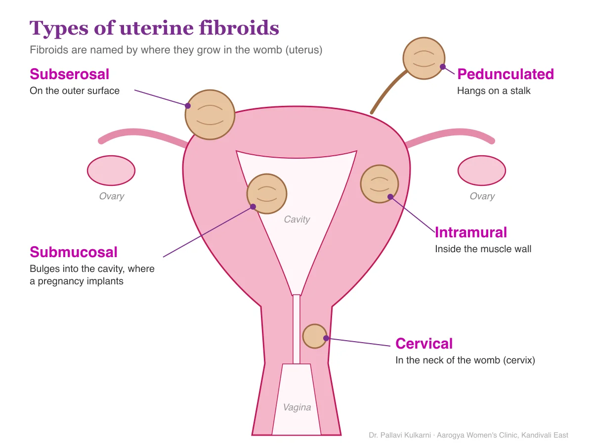 Diagram and picture of the types of uterine fibroids: subserosal, submucosal, intramural, pedunculated and cervical